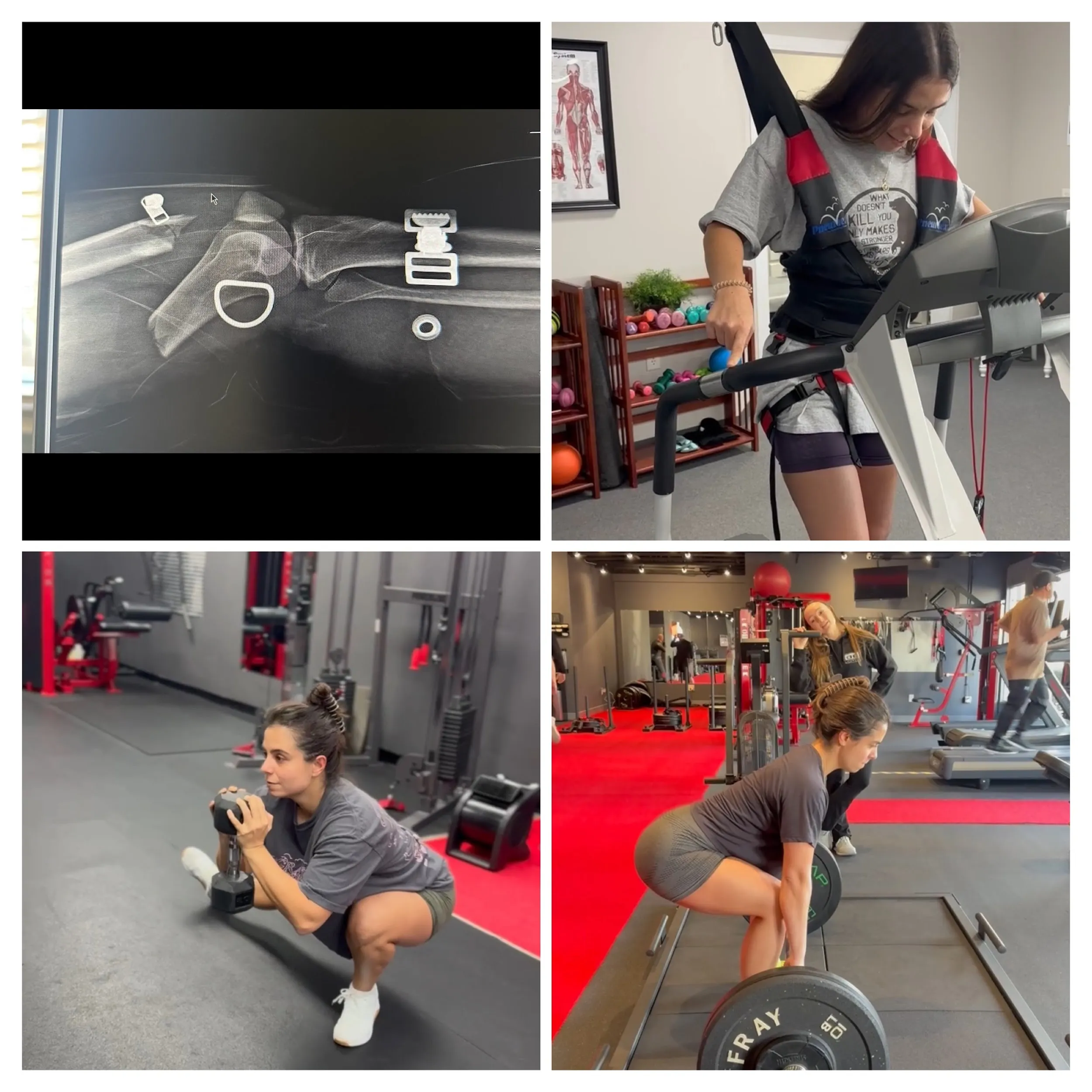 emily back to heavy squats after a broken leg with post-therapy training at darwin fitness